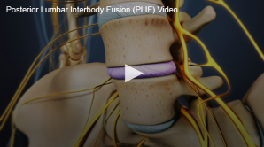 An educational video content showing the anatomical details of the human spine, focusing on the procedure known as posterior lumbar interbody fusion (plif).