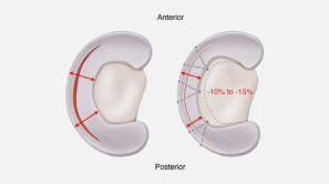 Video illustration of a knee joint with patella showing anterior and posterior views, including indications of reduced joint space marked with percentages.