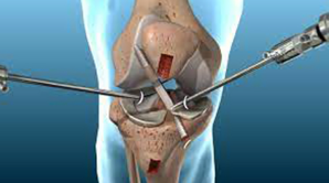 An illustration of a minimally invasive knee surgery procedure, showcasing arthroscopic instruments inserted into the knee joint for diagnostic or treatment purposes, complemented by videos.