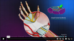 Anatomical video content illustrating carpal tunnel syndrome showing the median nerve being compressed in the wrist.