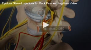 An illustrative video overlay on a human figure highlighting an epidural steroid injection procedure for treating herniated disc-related back and leg pain.