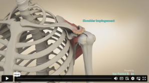 Anatomical illustration and videos of a human shoulder joint with a focus on the shoulder impingement area.