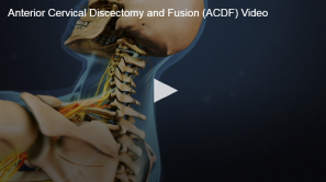 An anatomical visualization of a human neck highlighting the spine and nerve pathways, associated with an online video content on anterior cervical discectomy and fusion (acdf) surgery.