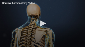 An online videos thumbnail featuring a human skeletal model with a focus on the cervical spine, indicating content about a cervical laminectomy procedure.