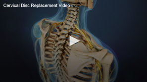 An animated illustration of a human cervical spine, highlighting a cervical disc replacement procedure, showcased in online videos.