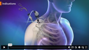 Medical animation showing a robotic device assisting with a procedure in the shoulder area of a human body, now available as video content online.