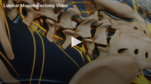 3D medical video displaying the lumbar region of the spine, highlighting a possible area for microdiscectomy surgery.