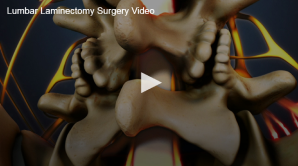 3d video content of the lumbar spine highlighting a potential area for laminectomy surgery.