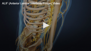 3D animation still from an educational video content demonstrating anterior lumbar interbody fusion (ALIF) procedure.