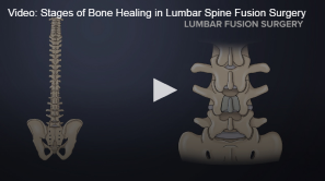 A graphic representation of a human spine next to a close-up of lumbar vertebrae, with an overlaid play button indicating videos about the stages of bone healing in lumbar spine fusion surgery.