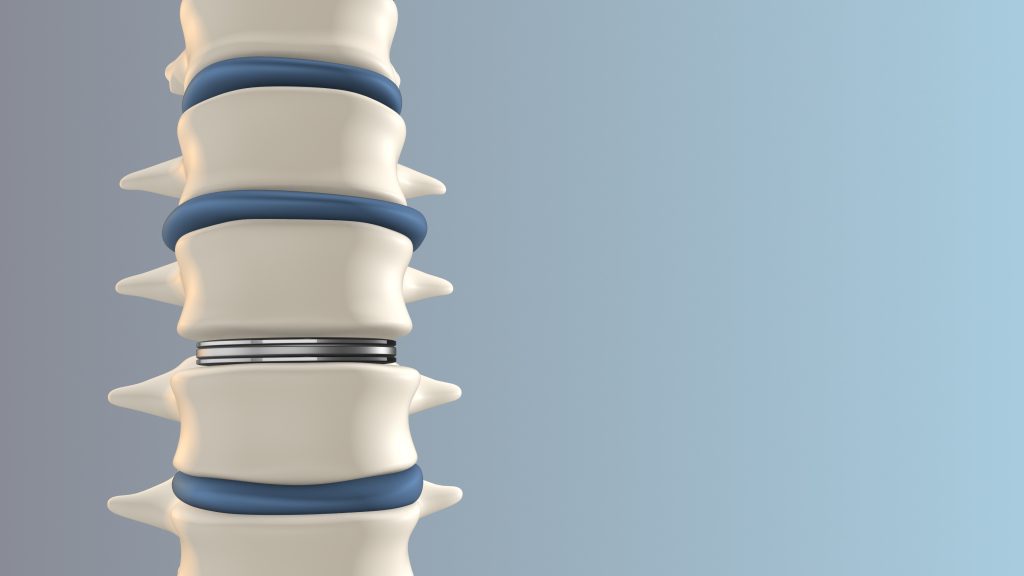A 3D illustration of a human spinal column with a focus on a cervical disk replacement implant.