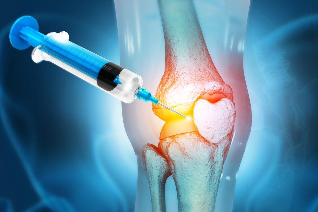 Digital illustration of a syringe injecting PalinGen InovoFlo into a human knee joint, highlighting the areas of treatment in an orthopedic context.