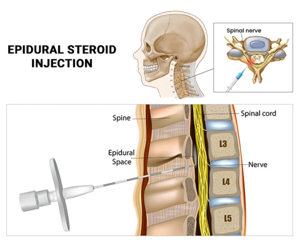 Epidural Steroid Injections